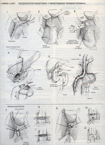 LAMINA V20135: Coledocoyeyunostomia y anastomosis terminoterminal