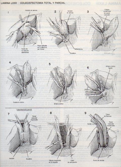 LAMINA V20133: Colecistectomia total y parcial