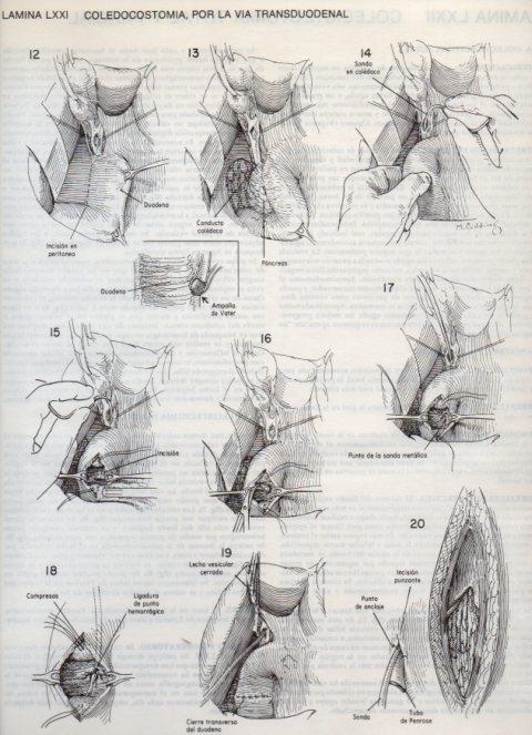 LAMINA V20132: Coledocostomia por la via transduodenal