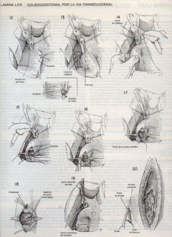LAMINA V20132: Coledocostomia por la via transduodenal