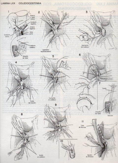 LAMINA V20131: Coledocostomia