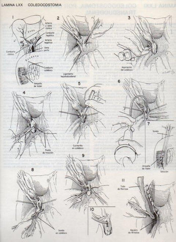 LAMINA V20131: Coledocostomia