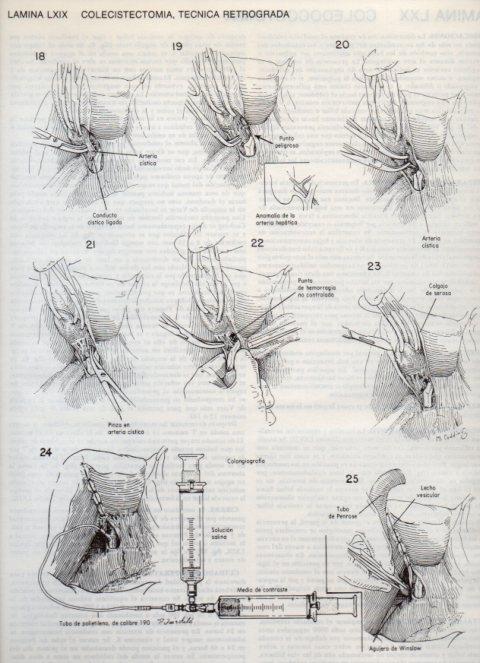 LAMINA V20130: Colecistectomia 2, tecnica retrograda