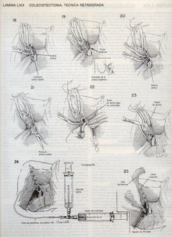 LAMINA V20130: Colecistectomia 2, tecnica retrograda