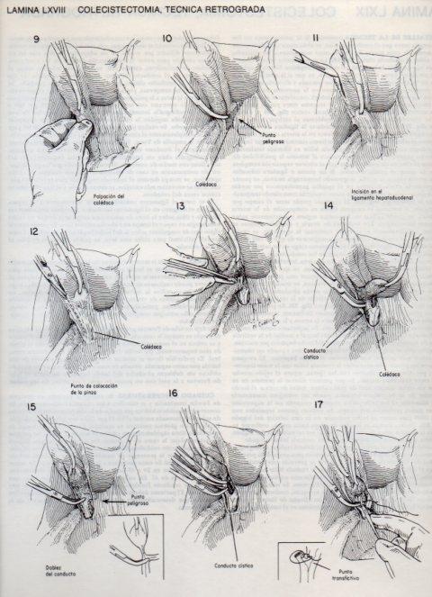 LAMINA V20129: Colecistectomia 1, tecnica retrograda