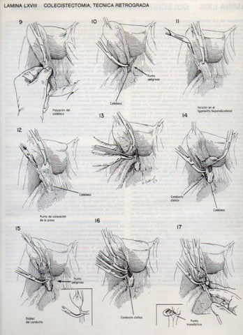 LAMINA V20129: Colecistectomia 1, tecnica retrograda