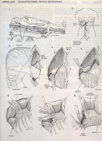 LAMINA V20128: Colecistectomia, tecnica retrograda