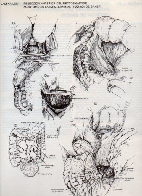 LAMINA V20125: Reseccion anterior del rectosigmoide: Anastomosis lateroterminal (tecnica de Baker) 3 