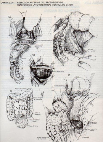 LAMINA V20125: Reseccion anterior del rectosigmoide: Anastomosis lateroterminal (tecnica de Baker) 3 