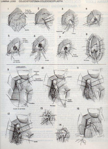 LAMINA V20134: Colecistostomia-Coledoscoplastia