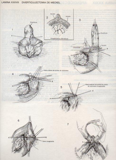 LAMINA V20099: Diverticulectomia de Meckel