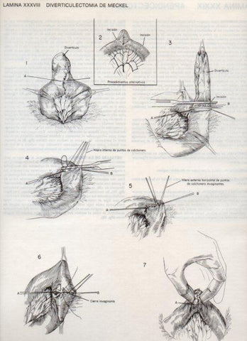 LAMINA V20099: Diverticulectomia de Meckel