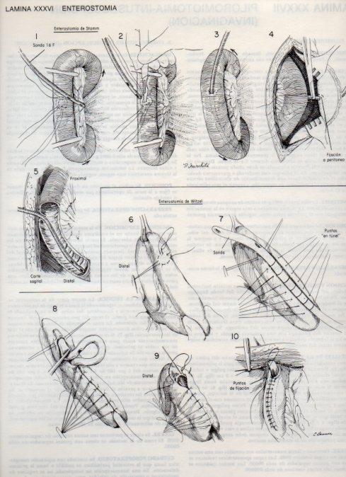 LAMINA V20097: Enterostomia