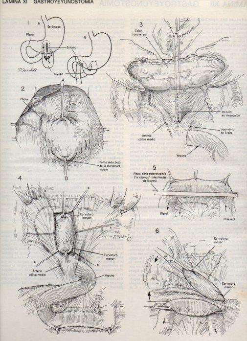 LAMINA V20072: Gastroyeyunostomia