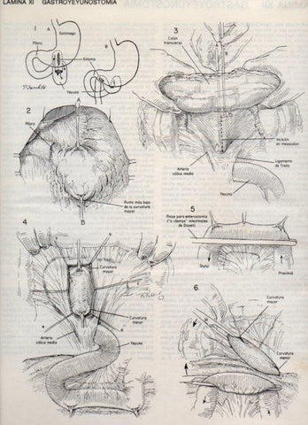LAMINA V20072: Gastroyeyunostomia