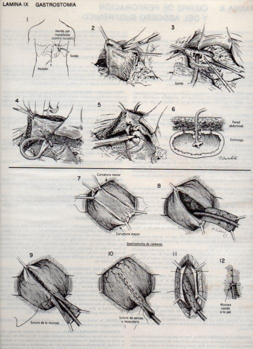 LAMINA V20070: Gastrostomia