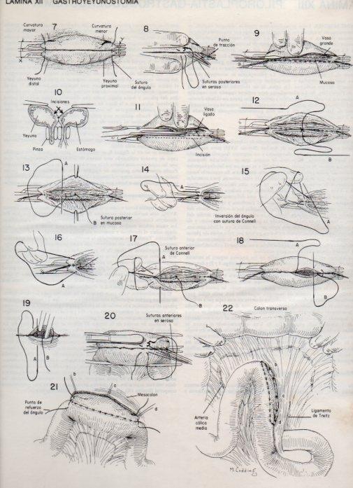 LAMINA V20073: Gastroyeyunostomia 1
