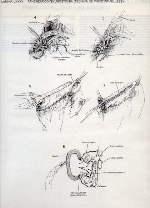 LAMINA V20145: Pancreaticoyeyunostomia, tecnica de Puestow-Gillesby 1