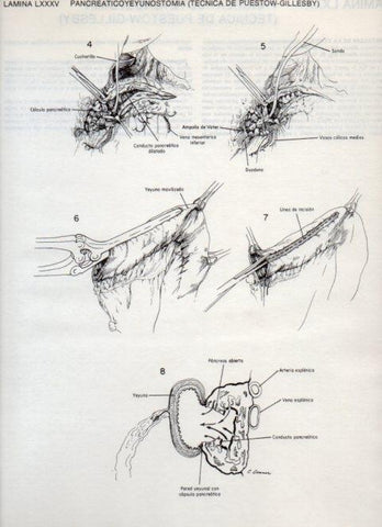LAMINA V20145: Pancreaticoyeyunostomia, tecnica de Puestow-Gillesby 1