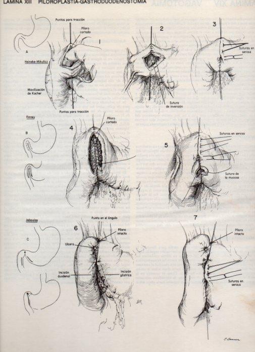 LAMINA V20074: Piloroplastia-gastroduodenostomia