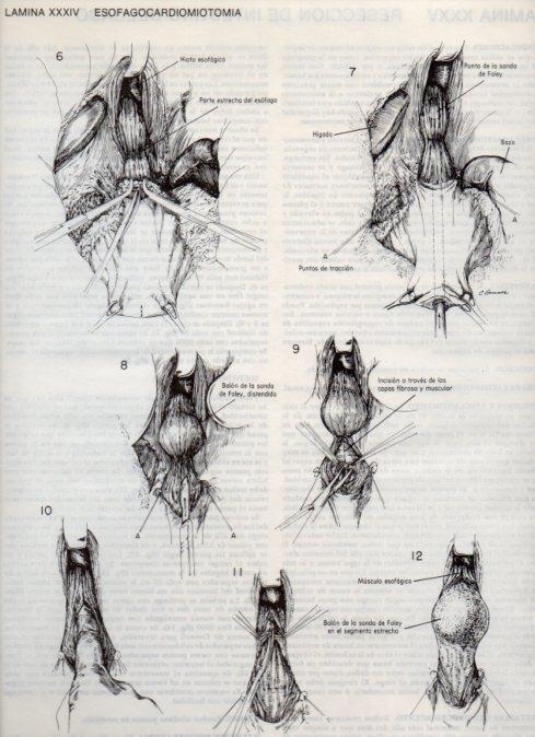 LAMINA V20095: Esofagocardiomiotomia 1
