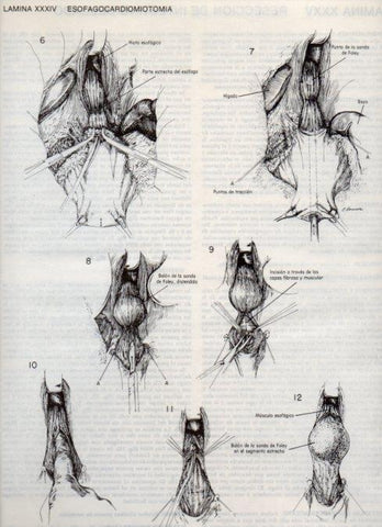LAMINA V20095: Esofagocardiomiotomia 1