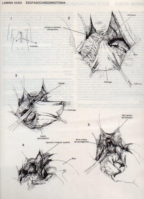 LAMINA V20094: Esofagocardiomiotomia