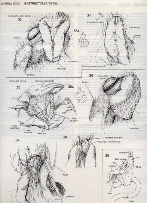 LAMINA V20093: Gastrectomia total 6