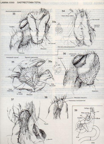 LAMINA V20093: Gastrectomia total 6