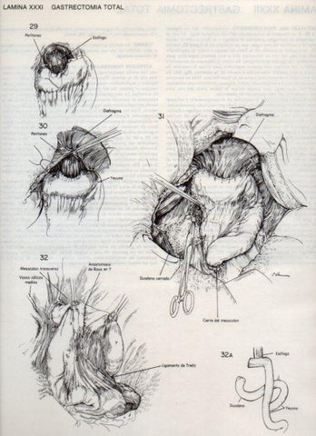 LAMINA V20092: Gastrectomia total 5