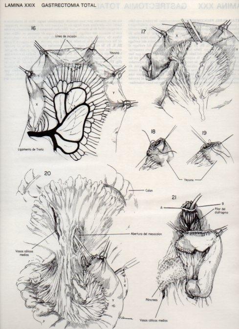 LAMINA V20090: Gastrectomia total 3