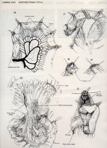 LAMINA V20090: Gastrectomia total 3
