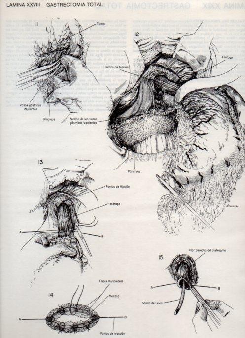 LAMINA V20089: Gastrectomia total 2