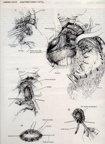 LAMINA V20089: Gastrectomia total 2