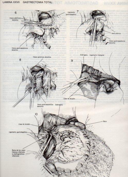 LAMINA V20088: Gastrectomia total 1
