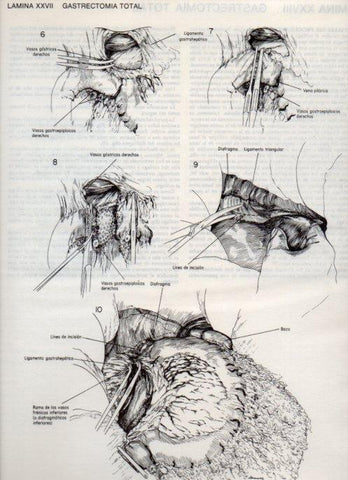 LAMINA V20088: Gastrectomia total 1