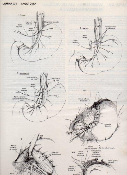 LAMINA V20075: Vagotomia