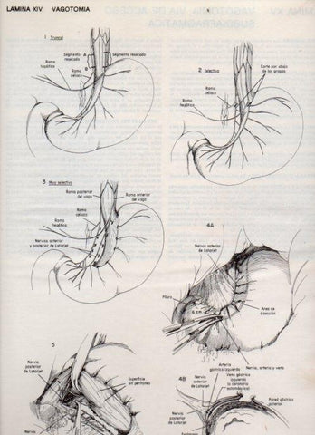 LAMINA V20075: Vagotomia