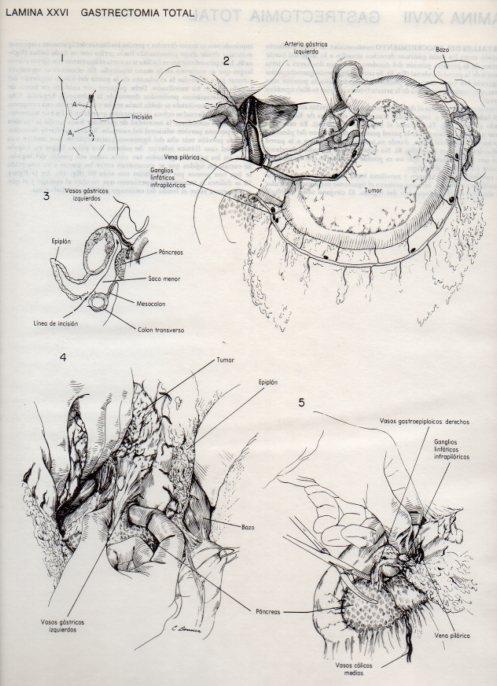 LAMINA V20087: Gastrectomia total 