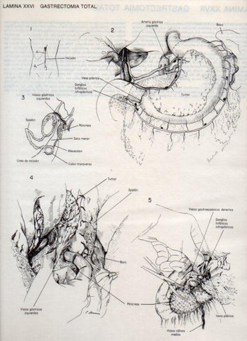 LAMINA V20087: Gastrectomia total 
