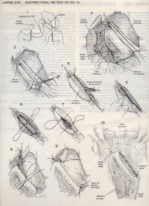LAMINA V20085: Gastrectomia, metodo de Polya
