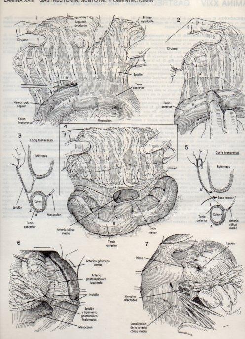 LAMINA V20084: Gastrectomia, subtotal y omentectomia
