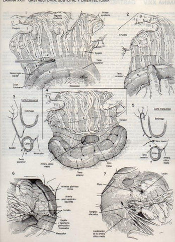 LAMINA V20084: Gastrectomia, subtotal y omentectomia