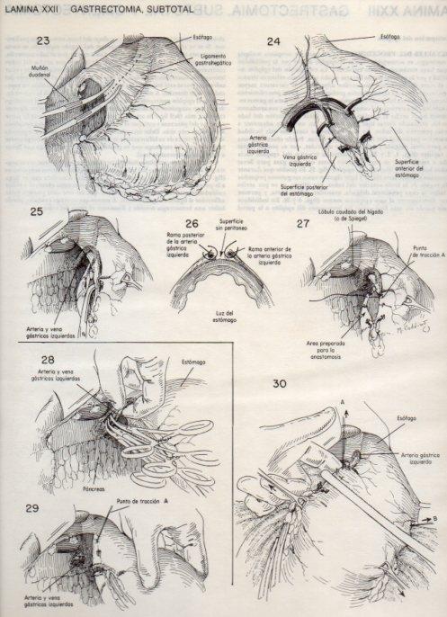 LAMINA V20083: Gastrectomia 3, subtotal