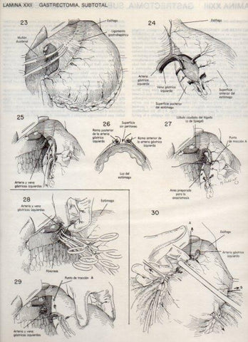LAMINA V20083: Gastrectomia 3, subtotal