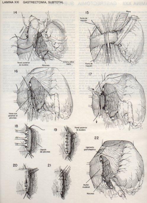 LAMINA V20082: Gastrectomia 2, subtotal 