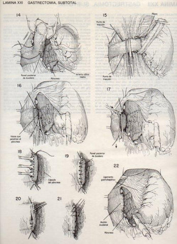 LAMINA V20082: Gastrectomia 2, subtotal 