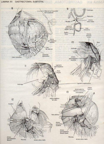 LAMINA V20081: Gastrectomia 1, subtotal 