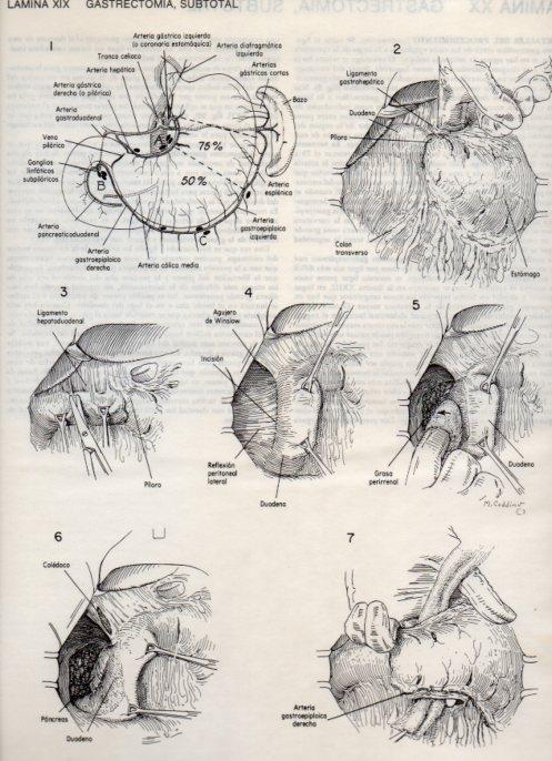 LAMINA V20080: Gastrectomia, subtotal