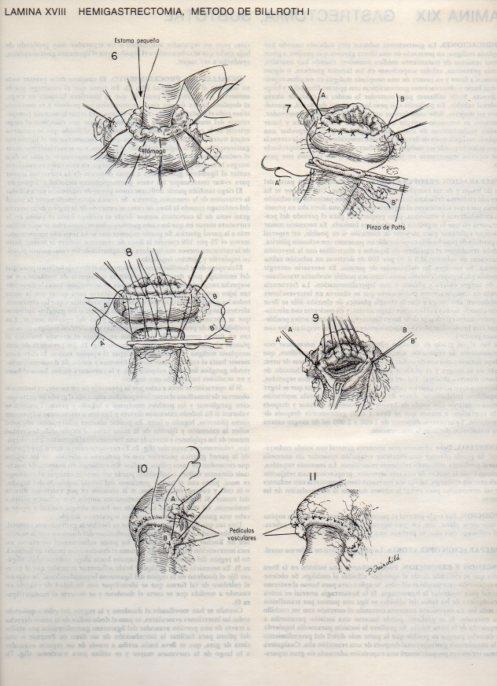 LAMINA V20079: Hemigastrectomia, metodo de Billroth I